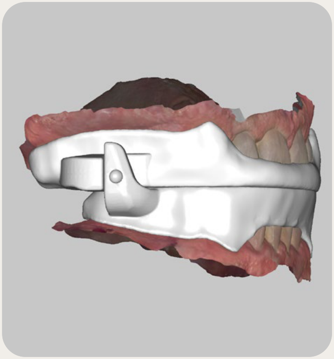 Side view showing the lower arch fin in front of the upper arch block
